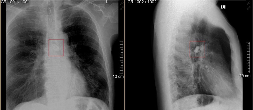 Das Röntgen-Bild zeigt den Fremdkörper in der Lunge.